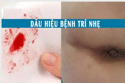 Dấu hiệu bệnh trĩ nhẹ có hình ảnh nhận biết