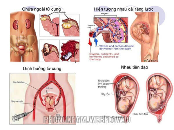 Thai ngoài tử cung là hiện tượng gì?