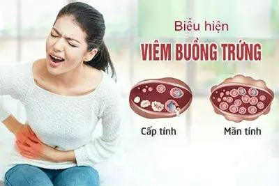 Dấu hiệu viêm buồng trứng thường gặp nhất