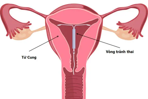 Địa chỉ đặt vòng tránh thai ở đâu tốt và uy tín tại Hà Nội