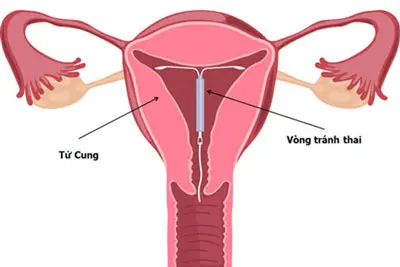 Địa chỉ đặt vòng tránh thai ở đâu tốt và uy tín tại Hà Nội