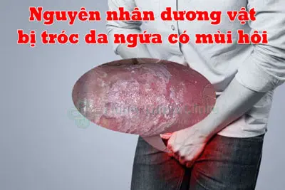 Dương vật bị tróc da và ngứa là bệnh gì? BS Nguyễn Lương Xu Tư Vấn