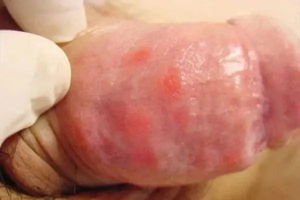Hình ảnh dương vật bị nổi mẩn đỏ do mụn rộp sinh dục trên người thật