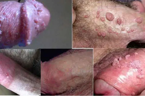 Hình ảnh dương vật bị nổi mẩn đỏ do sùi mào gà trên người thật