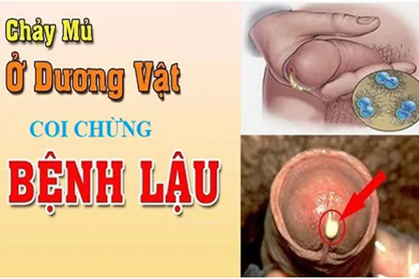 Dương vật chảy mủ nguyên nhân do bệnh lậu