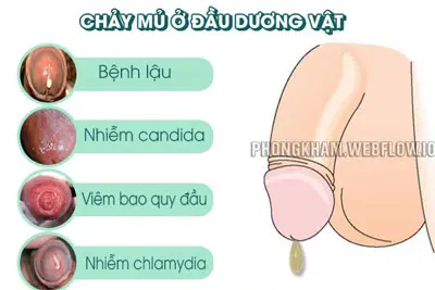 Dương vật chảy mủ là bệnh gì, cách chữa hiệu quả nhất 2025