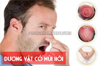 Dương vật có mùi hôi là bệnh gì, nguyên nhân cách chữa hiệu quả