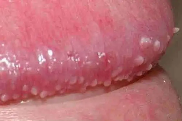 Gai sinh dục nam có nguy hiểm không BS Trần Thị Thành GIải đáp