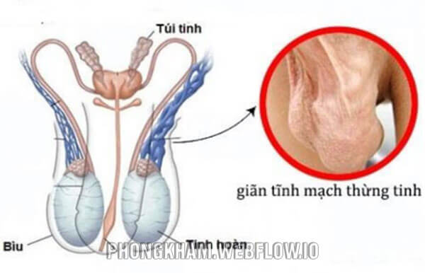 Giãn tĩnh mạch tinh hoàn là gì? nguyên nhân cách điều trị hiệu quả