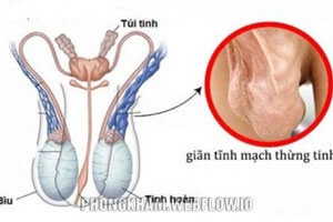 Giãn tĩnh mạch tinh hoàn là gì? nguyên nhân cách điều trị hiệu quả