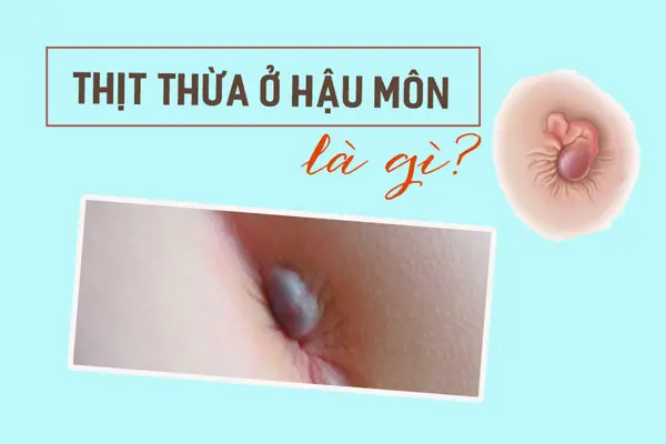 [Hình ảnh] Hậu môn có cục thịt dư là bị làm sao cách khắc phục