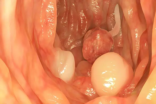 Hậu môn có cục thịt thừa do bệnh polyp hậu môn