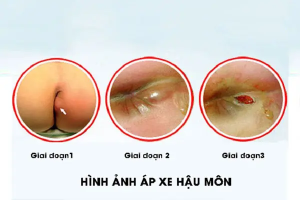 Mọc cục thịt thừa ở gần hậu môn do áp xe hậu môn