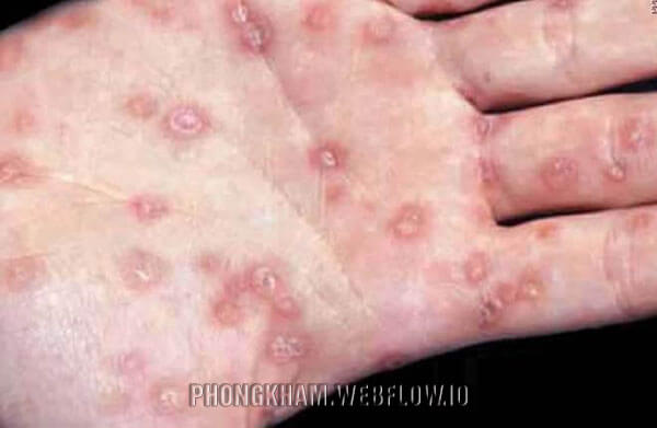 Hình ảnh bệnh giang mai giai đoạn đầu tiên