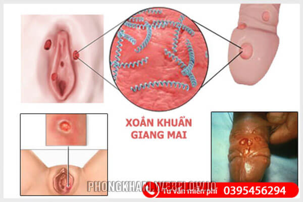 Hình ảnh bệnh giang mai ở bộ phận sinh dục