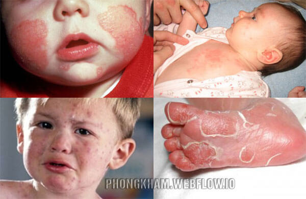 Hình ảnh bệnh giang mai ở trẻ em giới