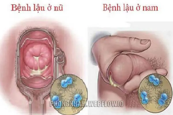 Hình ảnh bệnh lậu ở nam, nữ giới qua từng giai đoạn