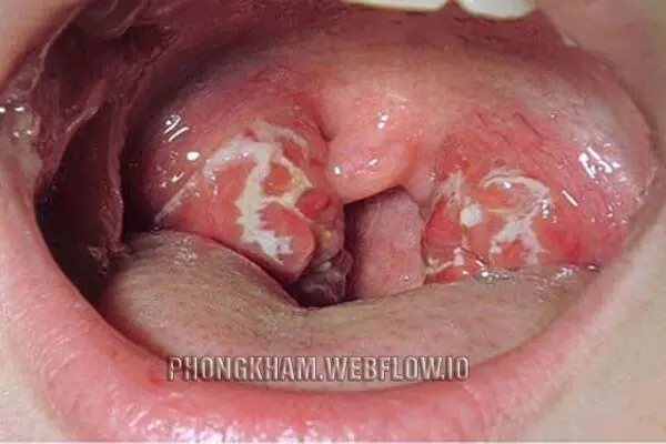 Hình ảnh bệnh lậu ở họng, miệng