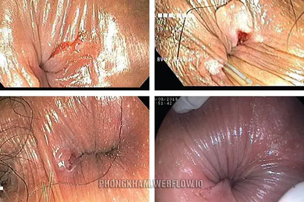 Hình ảnh bệnh lậu ở hậu môn