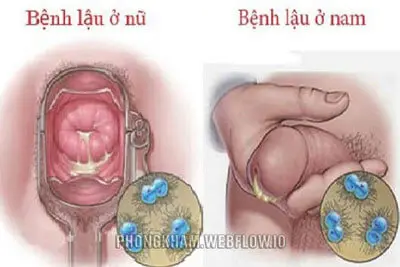 Hình ảnh bệnh lậu ở nam, nữ giới qua từng giai đoạn