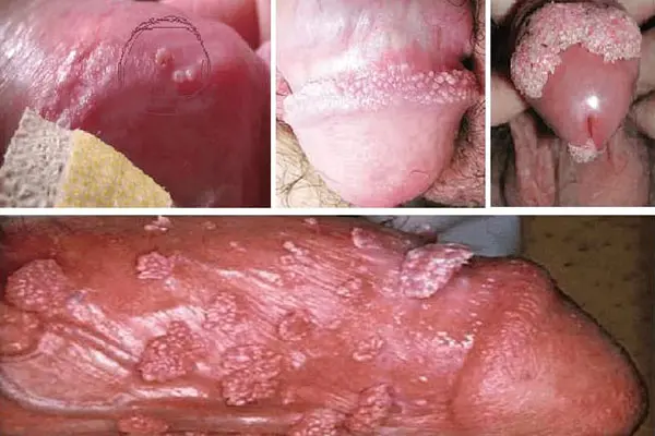 Hình ảnh bệnh sùi mào gà ở nam giới tại vùng kín