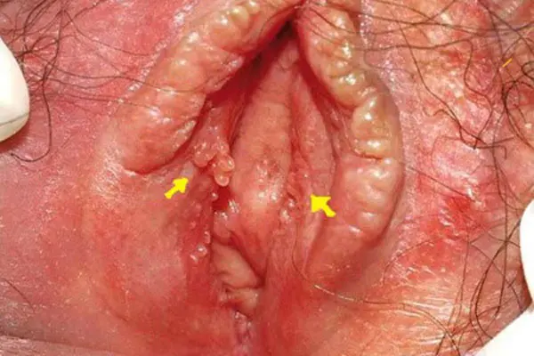 Hình ảnh bệnh sùi mào gà ở âm đạo nữ giới