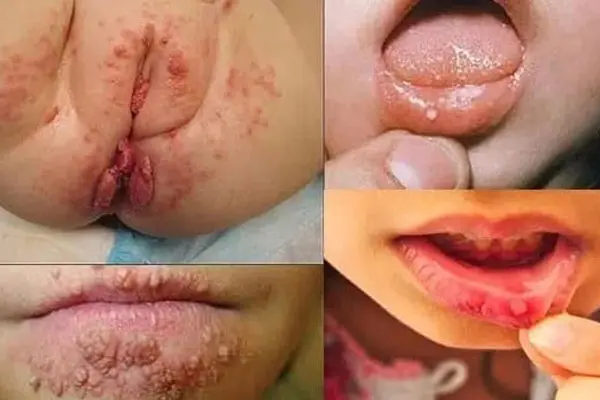 Hình ảnh sùi mào gà ở trẻ em