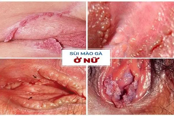 Hình ảnh bệnh sùi mào gà ở nữ giới tại vùng kín
