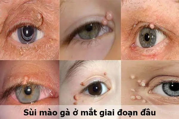 Hình ảnh sùi mào gà ở mắt