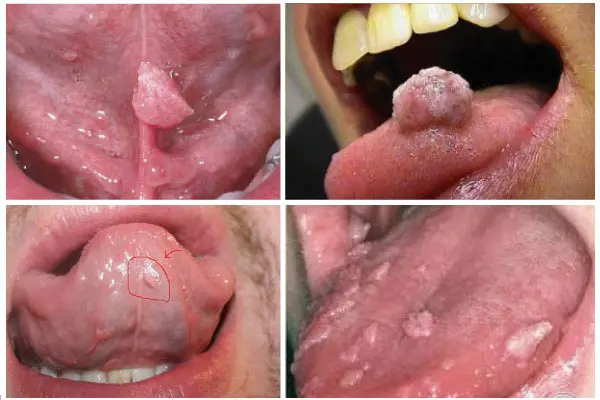 Hình ảnh sùi mào gà ở lưỡi, họng nam và nữ giới