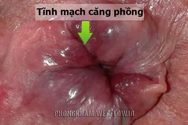 Hình ảnh bệnh trĩ ở nam giới độ 4