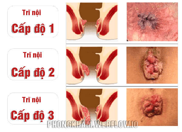 Hình ảnh Bệnh trĩ nội từ nhẹ đến nặng
