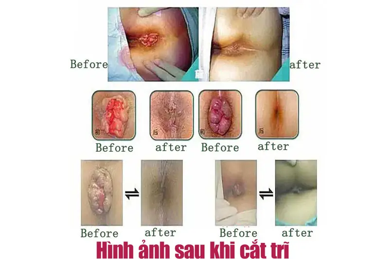 Hình ảnh sau khi cắt trĩ