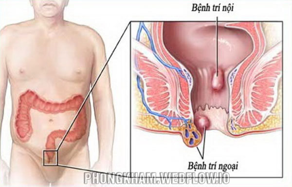 Hình ảnh bệnh trĩ giai đoạn đầu, nhẹ chi tiết cụ thể nhất