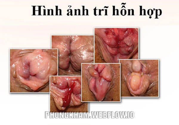 Hình ảnh Bệnh trĩ hỗn hợp ở các giai đoạn
