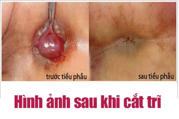 Hình ảnh sau khi cắt trĩ ngoại