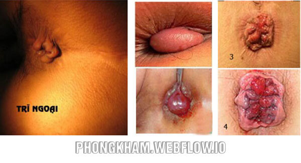 Hình ảnh bệnh trĩ ngoại nặng gây đau chảy máu