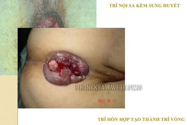 Hình ảnh Bệnh trĩ nội từ nhẹ đến nặng