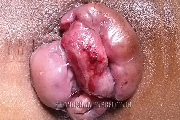 Hình ảnh bệnh trĩ ngoại ở nam giới độ 4