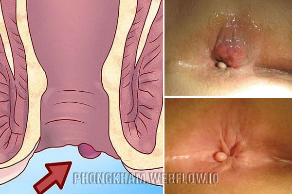 Hình ảnh bệnh trĩ ngoại nhẹ giai đoạn đầu