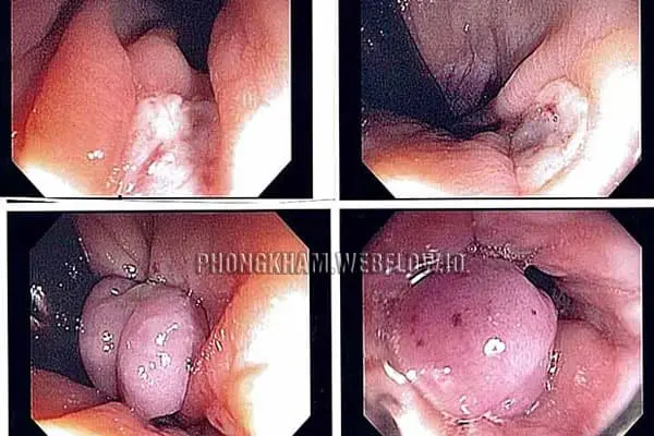 Hình ảnh Bệnh trĩ hỗn hợp