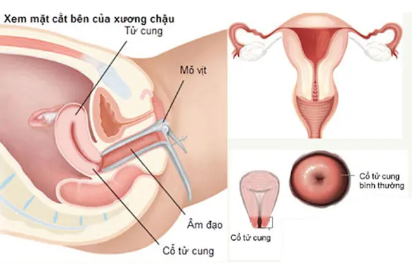 Thông tin triệu chứng nhận biết cổ tử cung đang gặp vấn đề