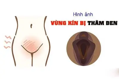 22+ Hình ảnh cô bé bị thâm đen và Cách khắc phục