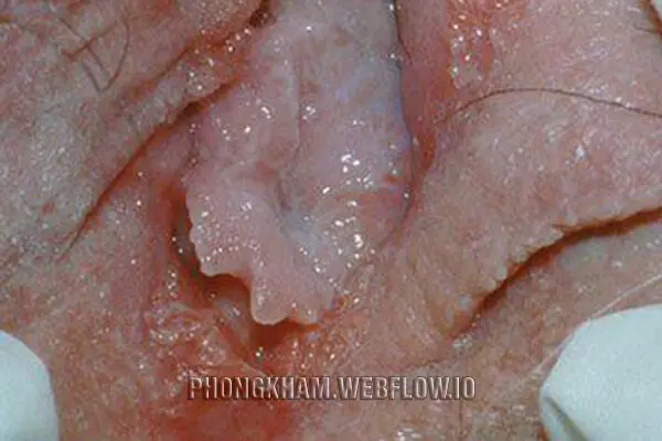 Nổi cục thịt ở vùng kín có thể là dấu hiệu bệnh sùi mào gà