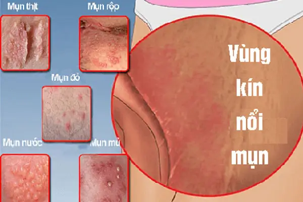 Nổi mụn ở vùng kín cảnh báo bệnh mụn rộp sinh dục