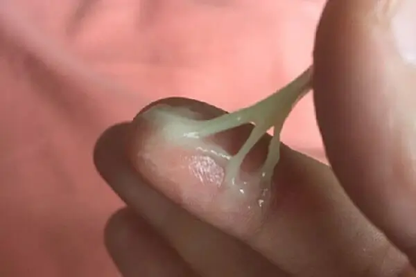  Khí hư có màu xanh bất thường