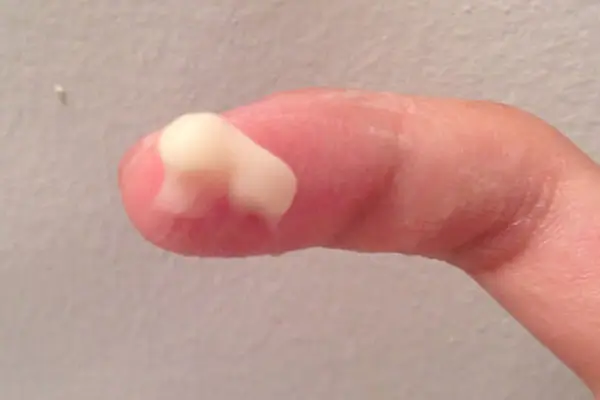 Hình ảnh khí hư bất thường: Khí hư có màu vàng