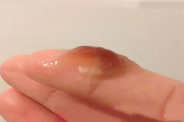 Hình ảnh khí hư bất thường - Khí hư có màu nâu, đen