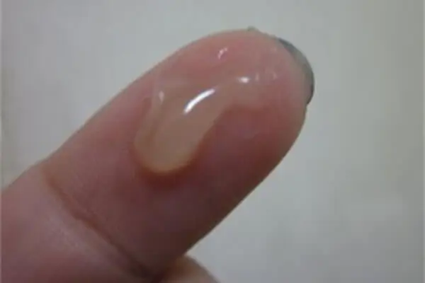 Hình ảnh khí hư bất thường màu xám