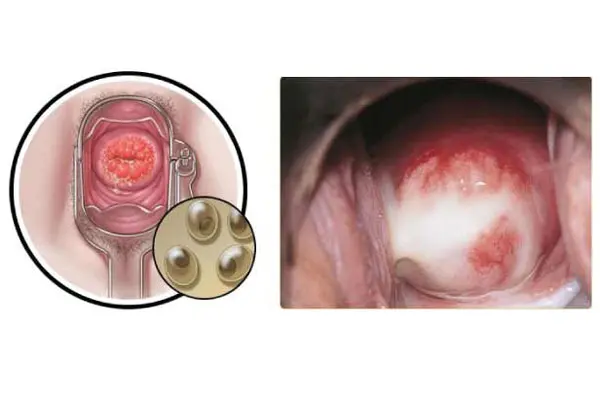 Mắc các bệnh lây truyền qua đường tình dục